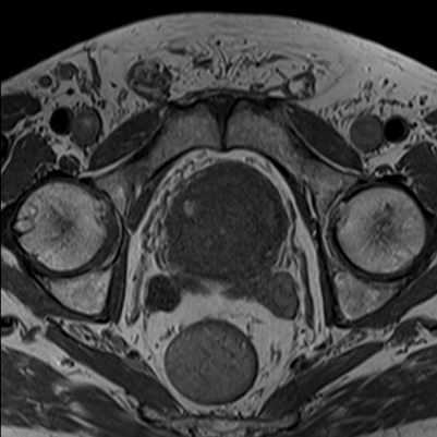 rmn prostata cu substanta de contrast semne de prostatită herpetică