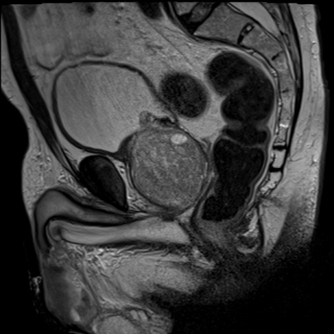 rmn prostata cu substanta de contrast cauze dureri rinichi